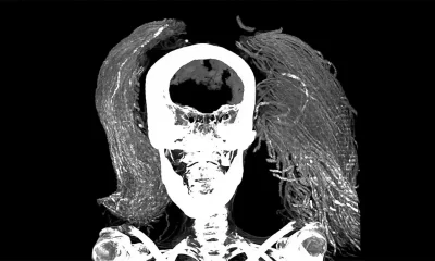 Radiografia Da Múmia Da &Quot;Mulher Gritando&Quot;. Crédito: Sahar Saleem