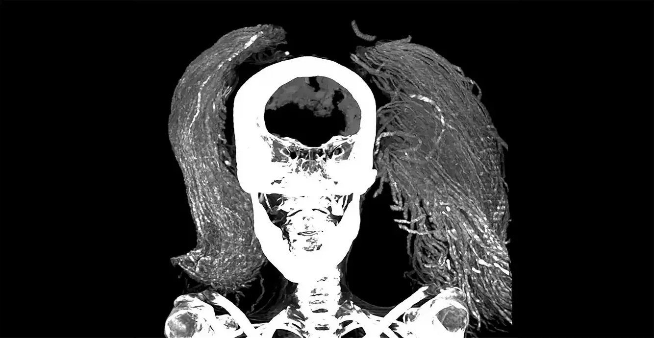 Radiografia Da Múmia Da &Quot;Mulher Gritando&Quot;. Crédito: Sahar Saleem